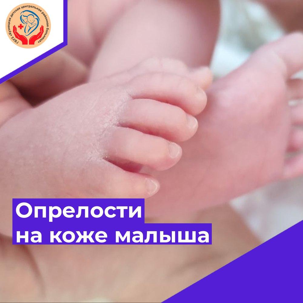 Опрелости на коже малыша