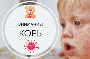 В Кузнецке зафиксирован случай заболевания корью